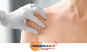 Родинка, которая растет Родинка, которая растет