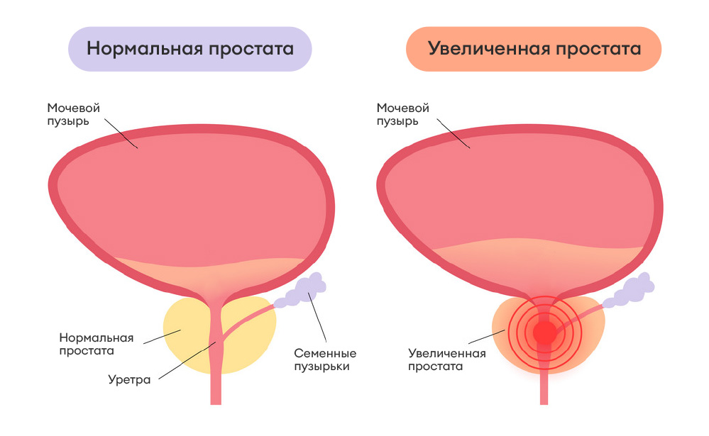 Что такое простатит