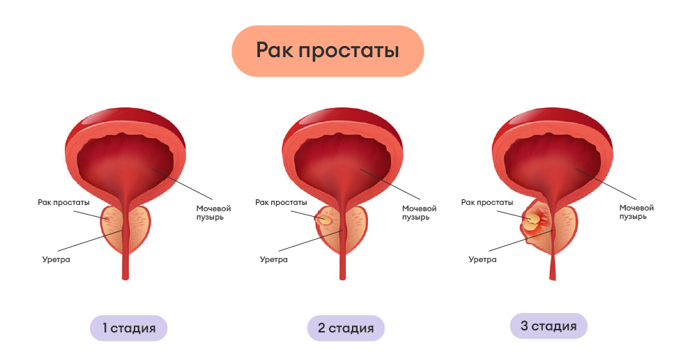 Рак простаты помогите