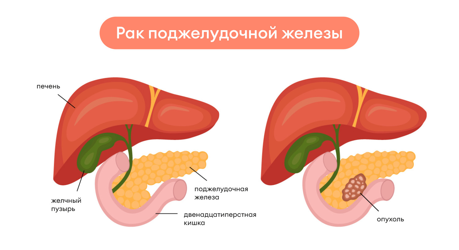 Рак поджелудочной железы