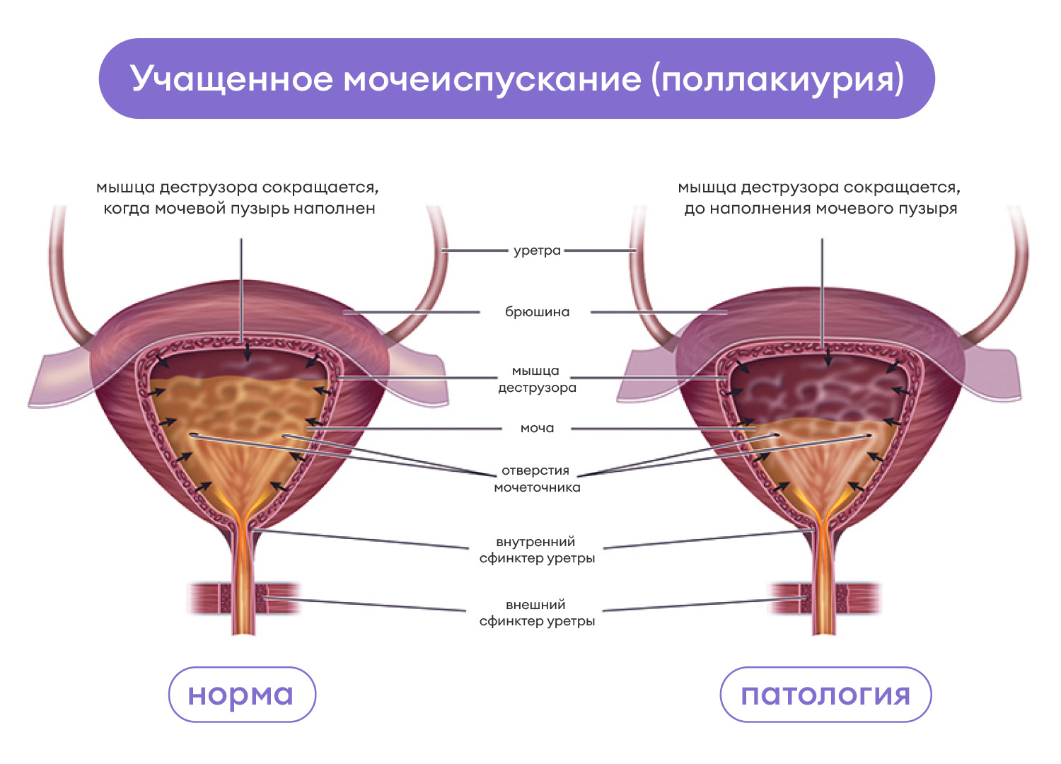 причины учащенного мочеиспускания