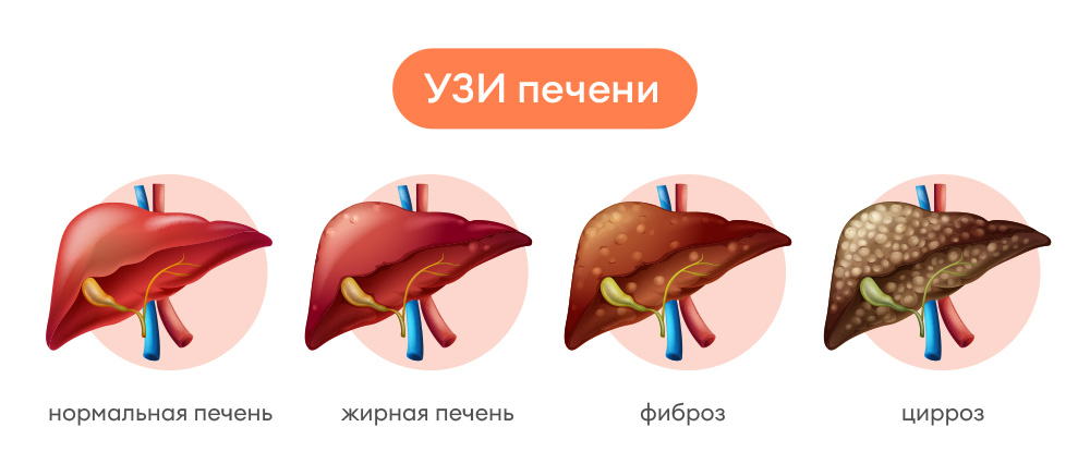 Показания к Узи печени