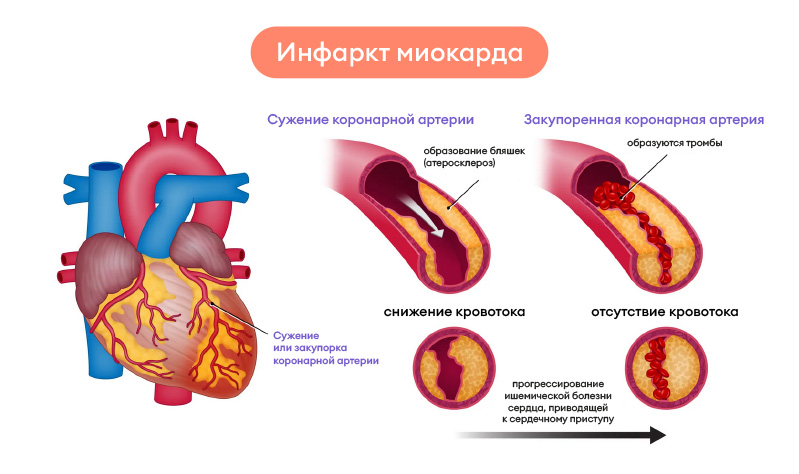 Симптомы инфаркта