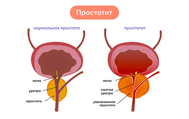 Лечение простатита