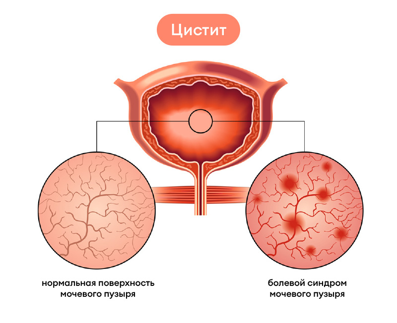 Из-за чего появляется цистит у мужчин 