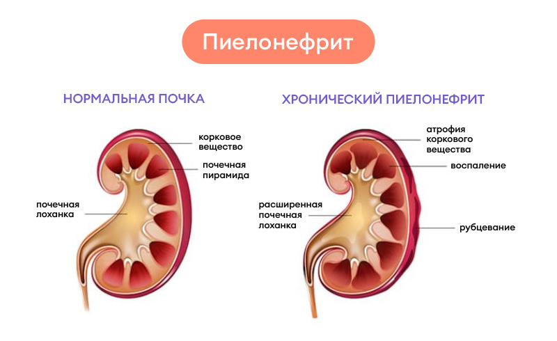 Пиелонефрит почек