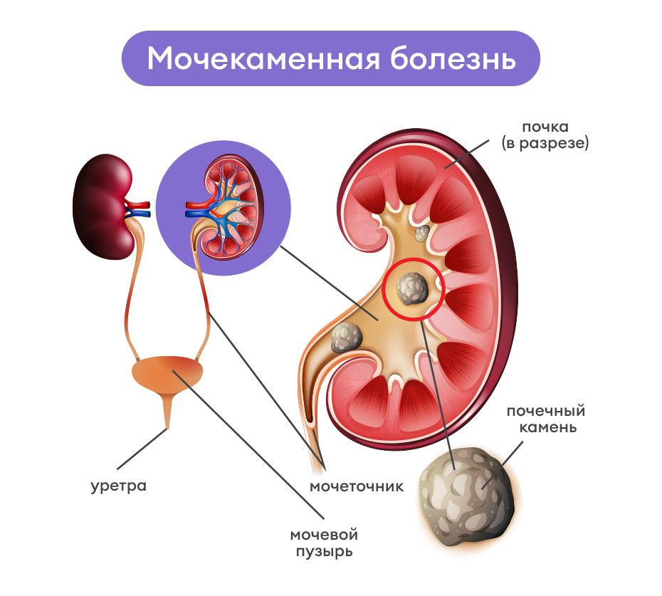 Виды мочекаменной болезни