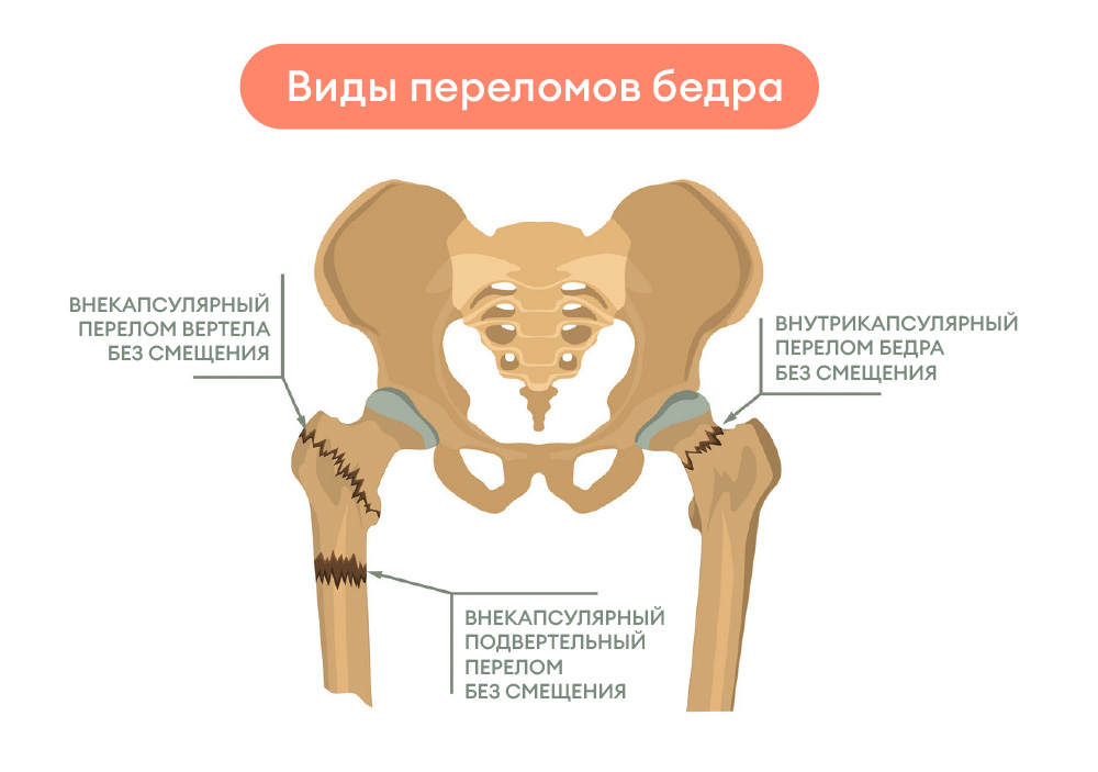 Виды переломов бедра